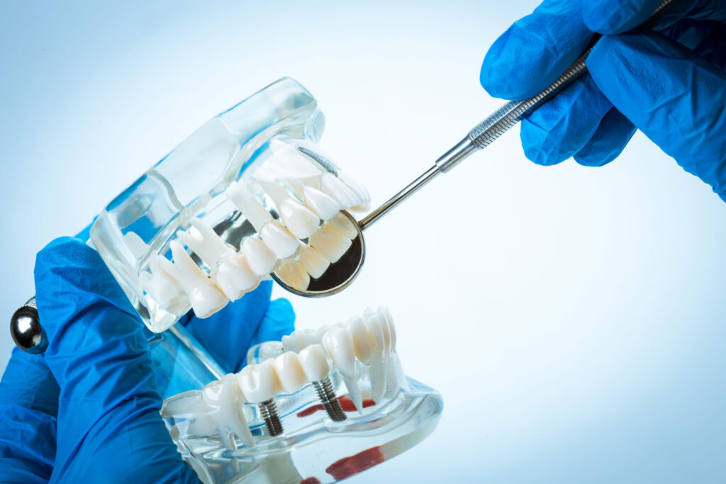 Implantatsmodell transparent mit spiegel